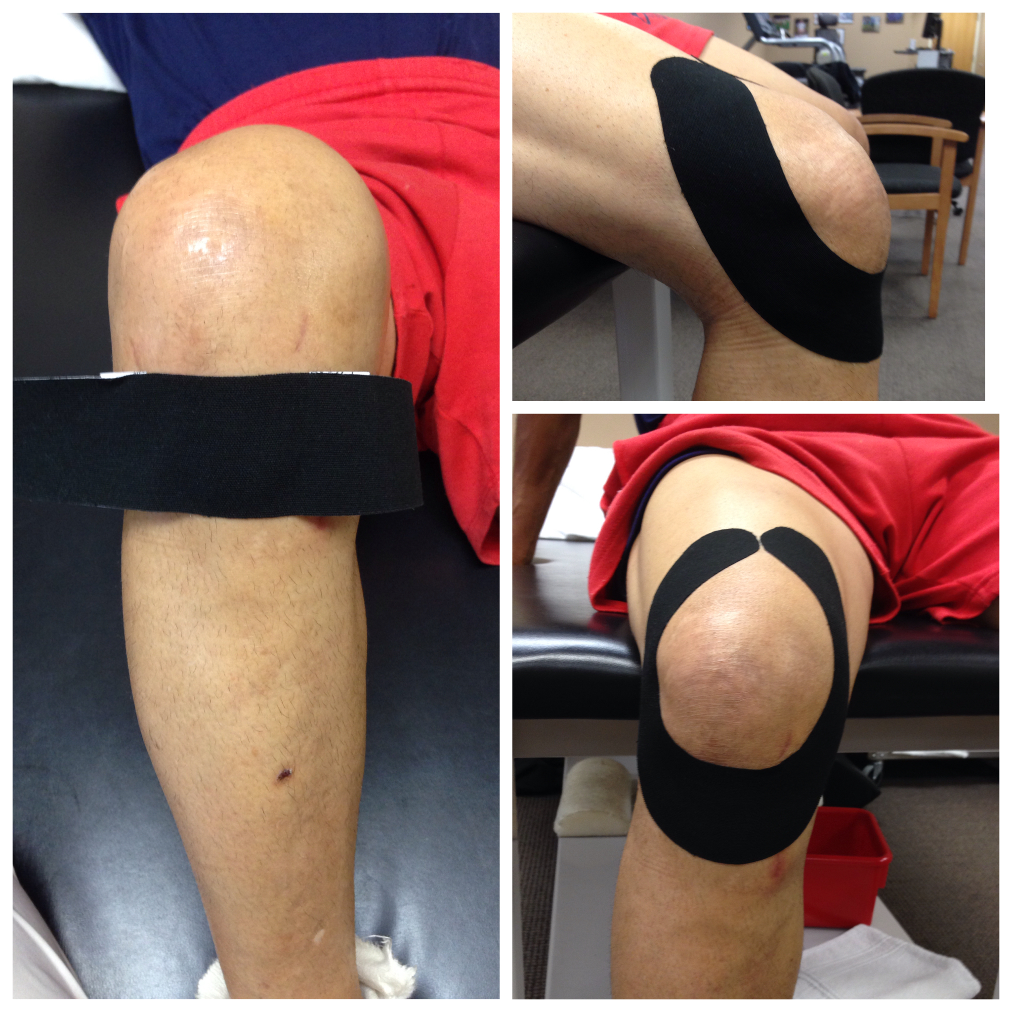 Kinesiology Taping Tecnique For Knee Pain